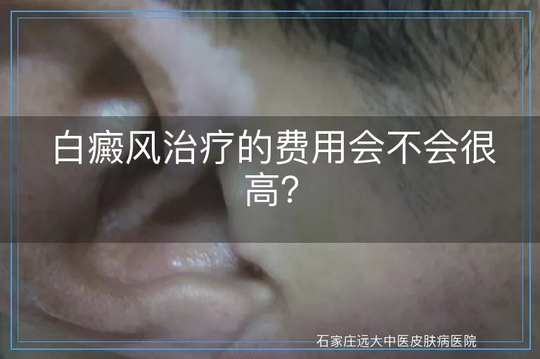 白癜风治疗的费用会不会很高?