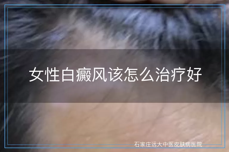 女性白癜风该怎么治疗好