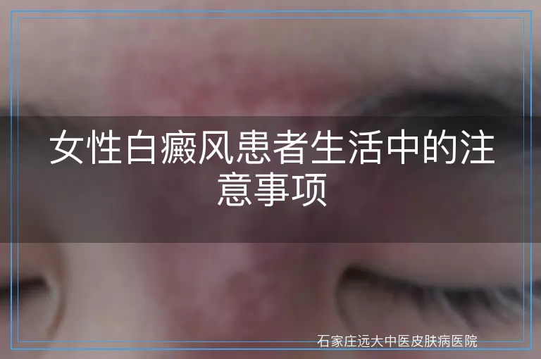 女性白癜风患者生活中的注意事项