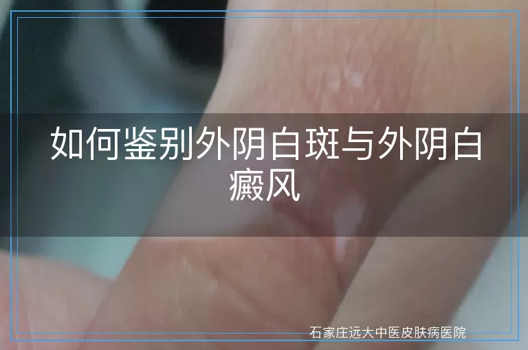 如何鉴别外阴白斑与外阴白癜风