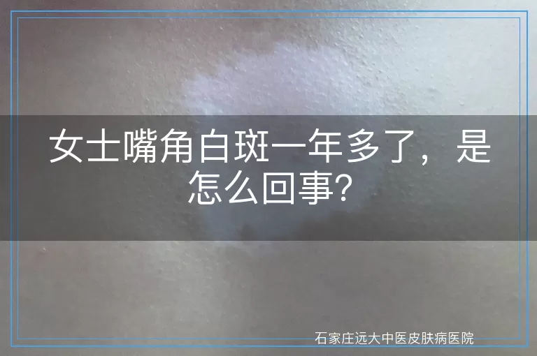 女士嘴角白斑一年多了,是怎么回事?