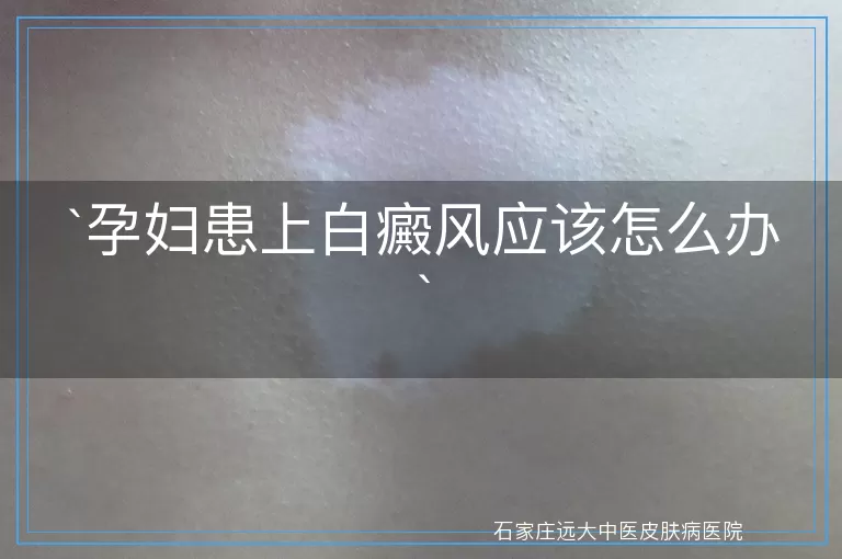 孕妇患上白癜风应该怎么办