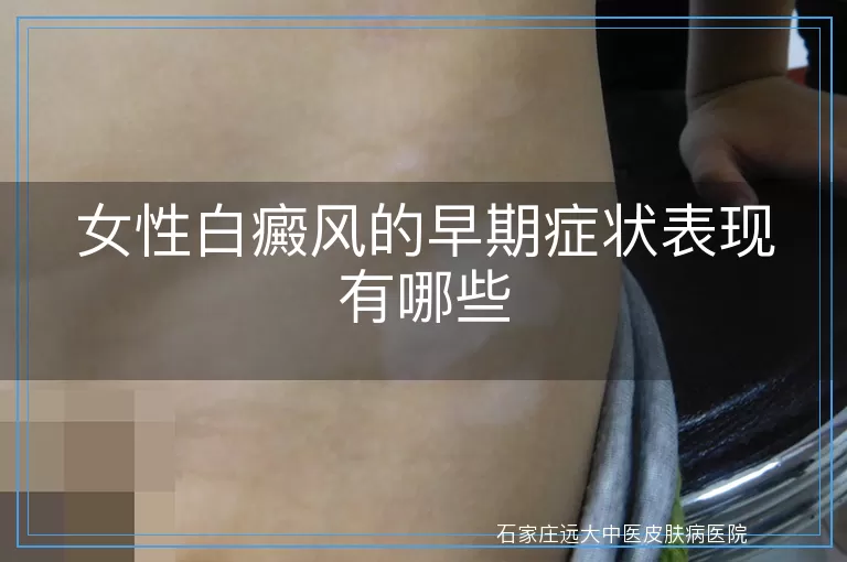 女性白癜风的早期症状表现有哪些