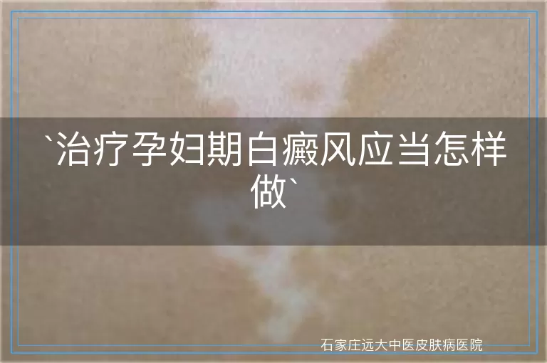 治疗孕妇期白癜风应当怎样做