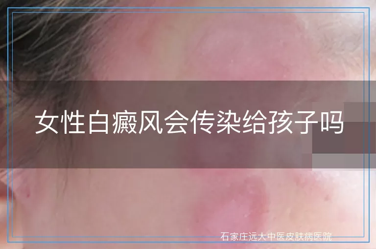 女性白癜风会传染给孩子吗