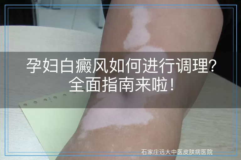 孕妇白癜风如何进行调理？全面指南来啦！