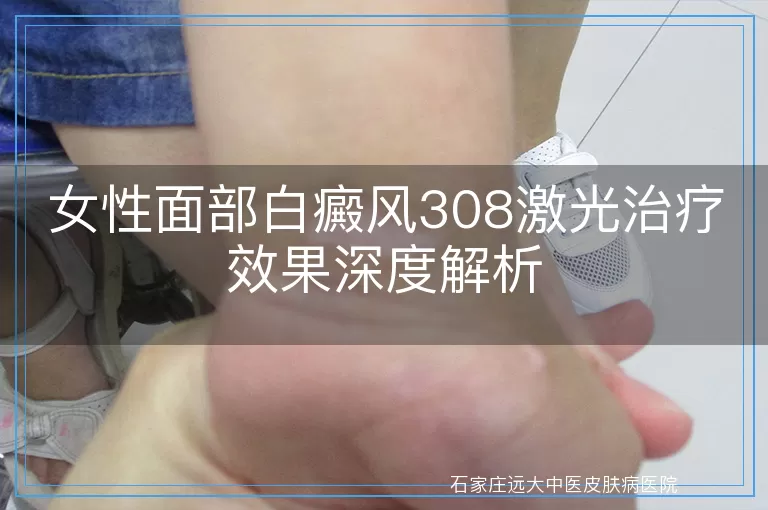 女性面部白癜风308激光治疗效果深度解析