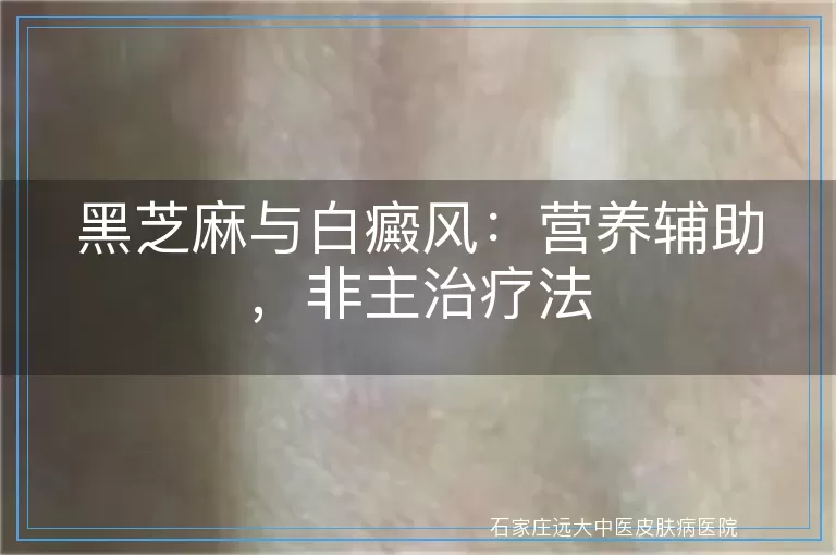 黑芝麻与白癜风：营养辅助，非主治疗法
