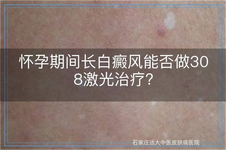 怀孕期间长白癜风能否做308激光治疗？