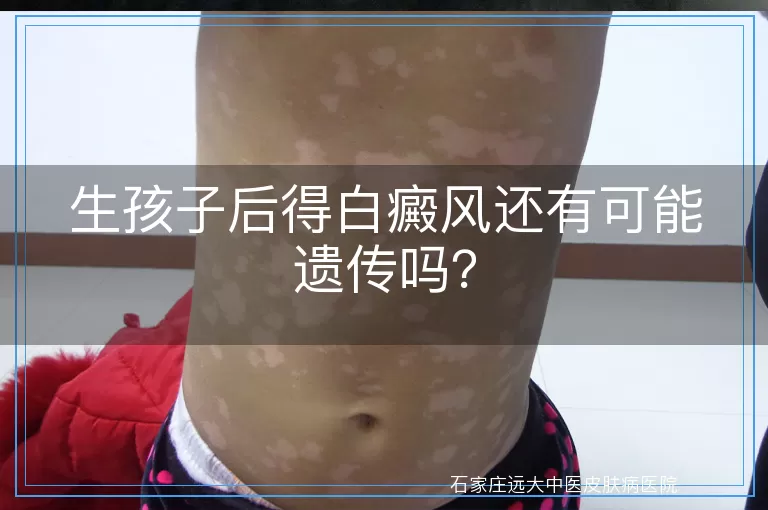 生孩子后得白癜风还有可能遗传吗？