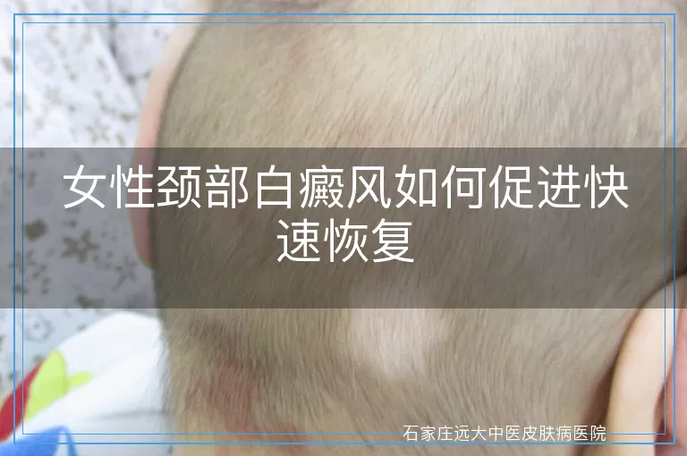 女性颈部白癜风如何促进快速恢复