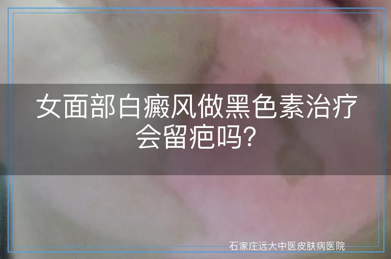 女面部白癜风做黑色素治疗会留疤吗？