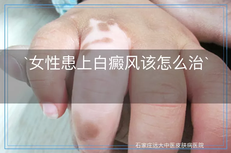 女性患上白癜风该怎么治