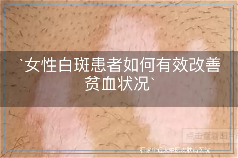 女性白斑患者如何有效改善贫血状况