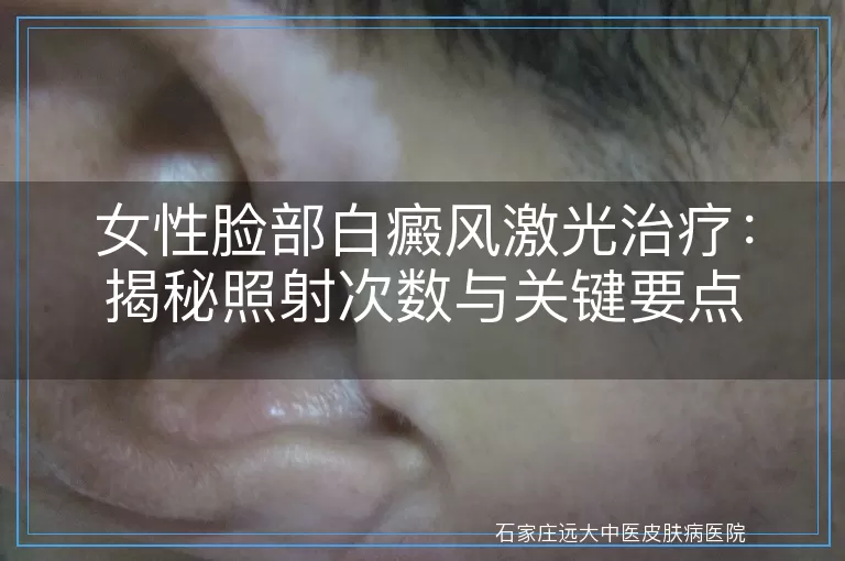 女性脸部白癜风激光治疗：揭秘照射次数与关键要点