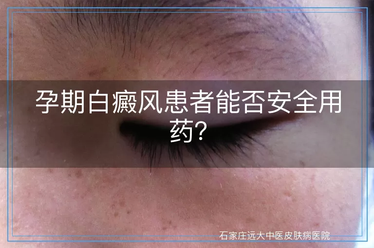 孕期白癜风患者能否安全用药？