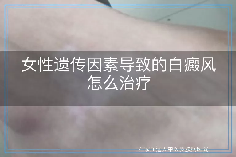 女性遗传因素导致的白癜风怎么治疗