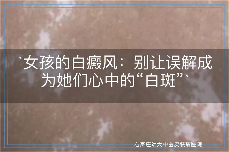 女孩的白癜风：别让误解成为她们心中的“白斑”