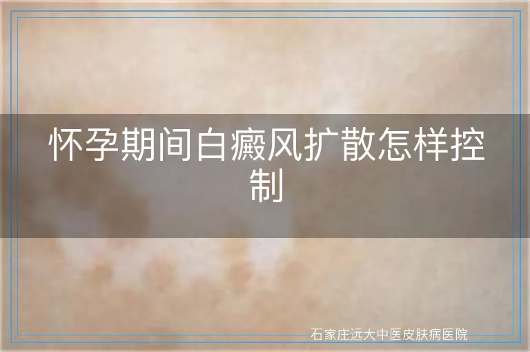 怀孕期间白癜风扩散怎样控制