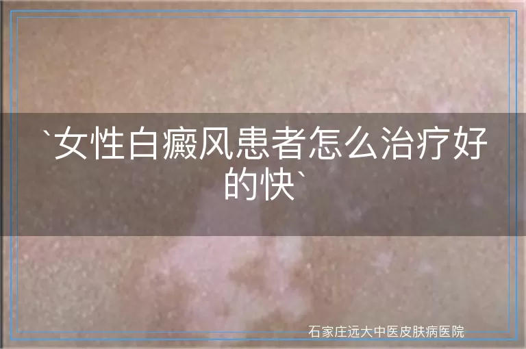 女性白癜风患者怎么治疗好的快
