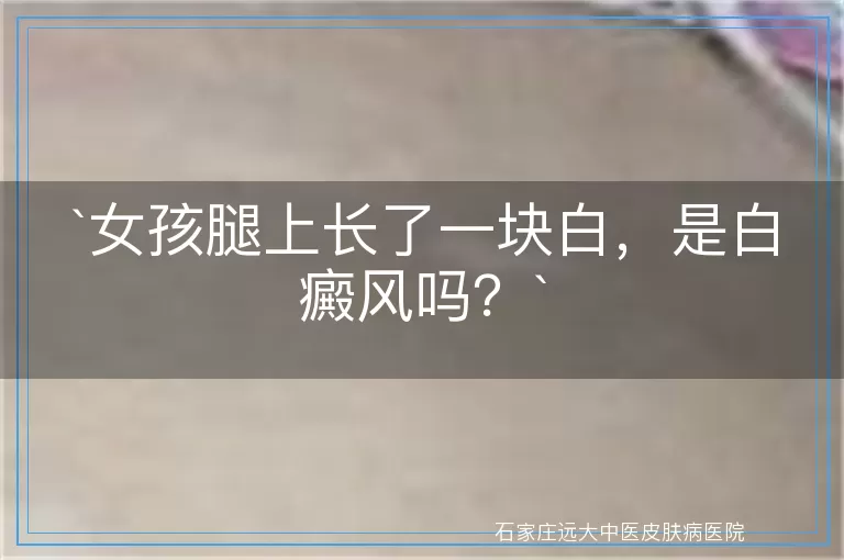 女孩腿上长了一块白，是白癜风吗？