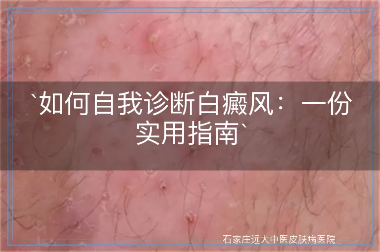 如何自我诊断白癜风：一份实用指南