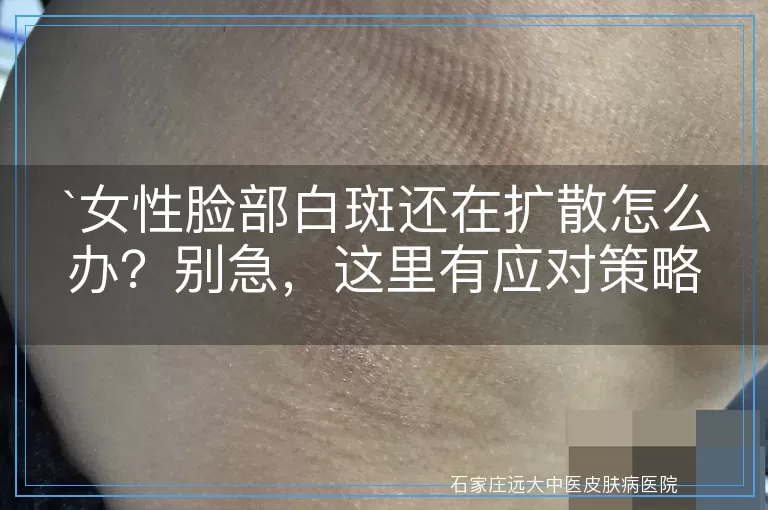 女性脸部白斑还在扩散怎么办？别急，这里有应对策略！