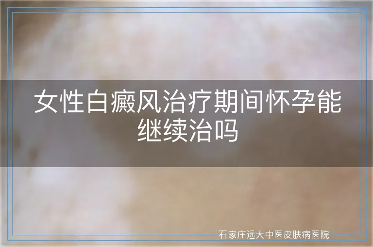 女性白癜风治疗期间怀孕能继续治吗