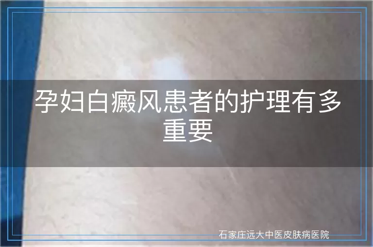 孕妇白癜风患者的护理有多重要