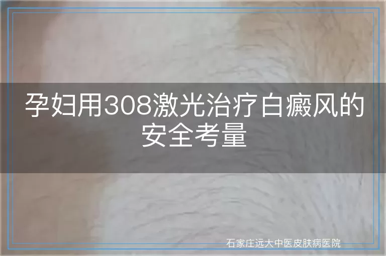 孕妇用308激光治疗白癜风的安全考量