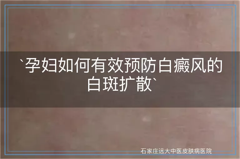 孕妇如何有效预防白癜风的白斑扩散