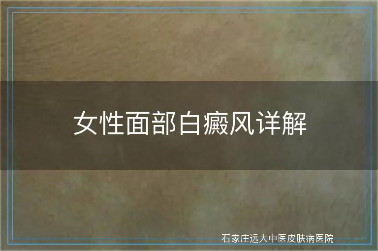 女性面部白癜风详解