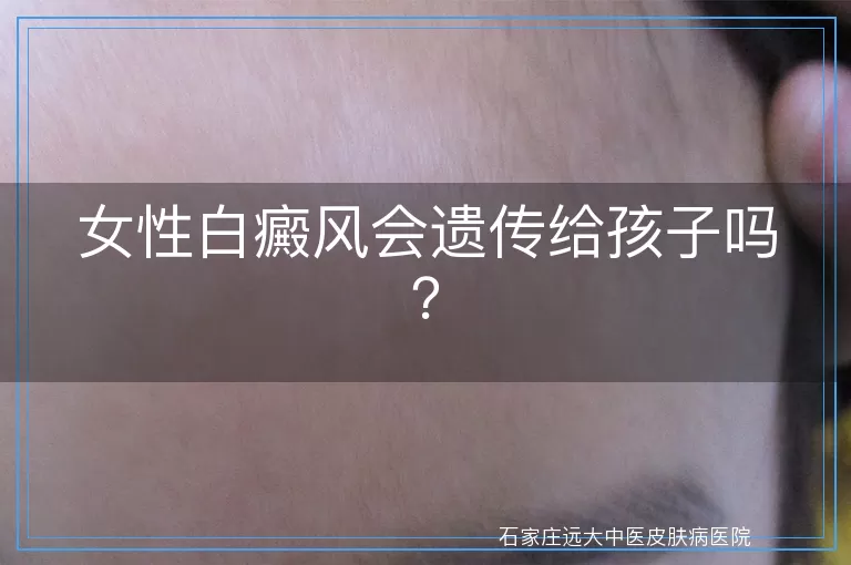 女性白癜风会遗传给孩子吗？
