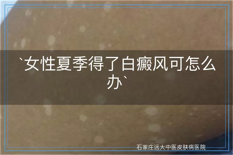 女性夏季得了白癜风可怎么办