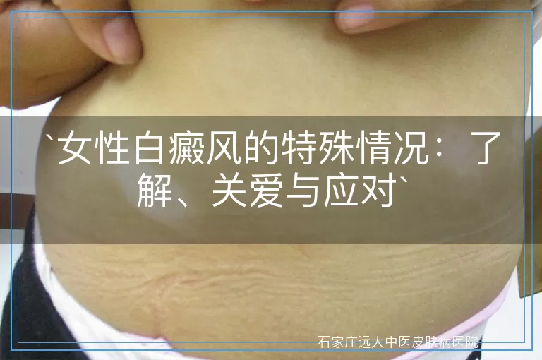 女性白癜风的特殊情况：了解、关爱与应对