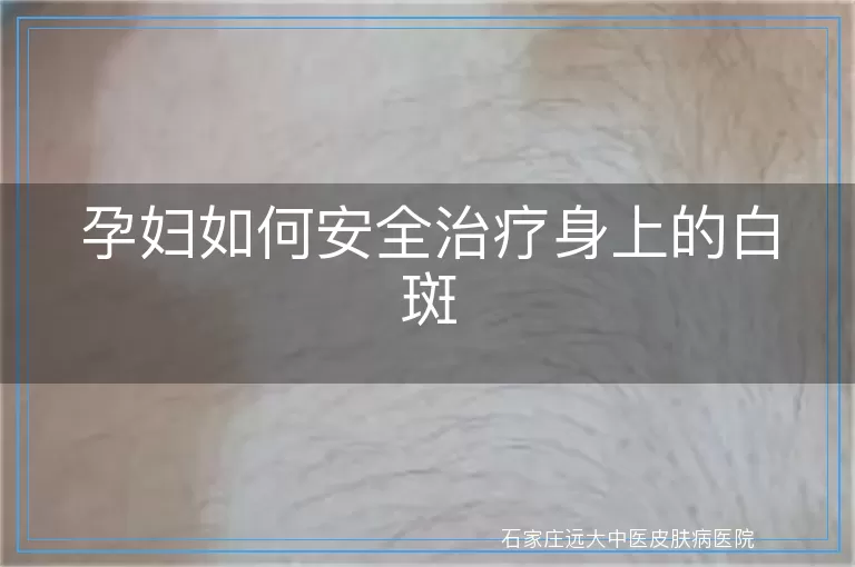 孕妇如何安全治疗身上的白斑