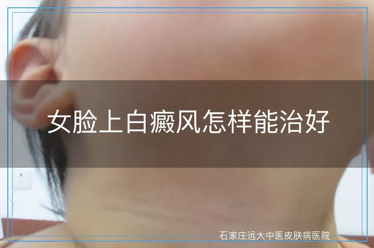 女脸上白癜风怎样能治好