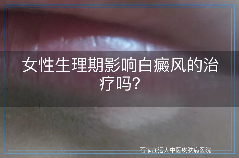 女性生理期影响白癜风的治疗吗？