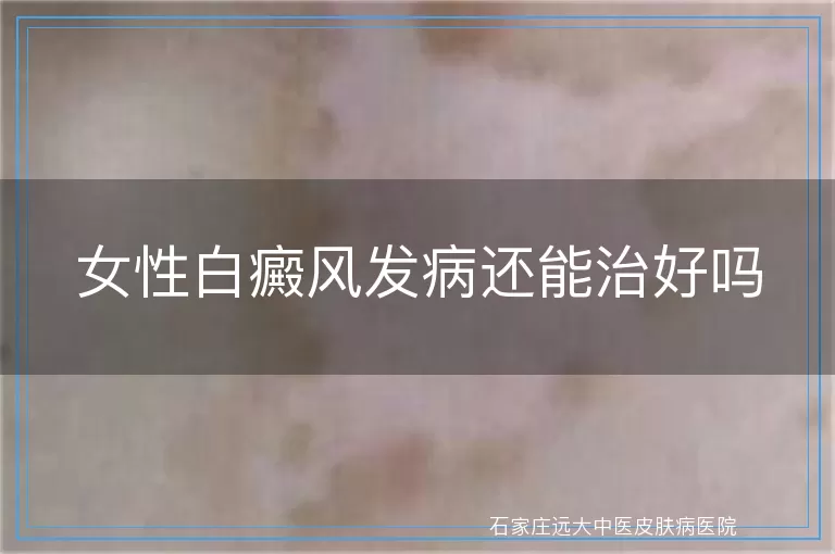 女性白癜风发病还能治好吗