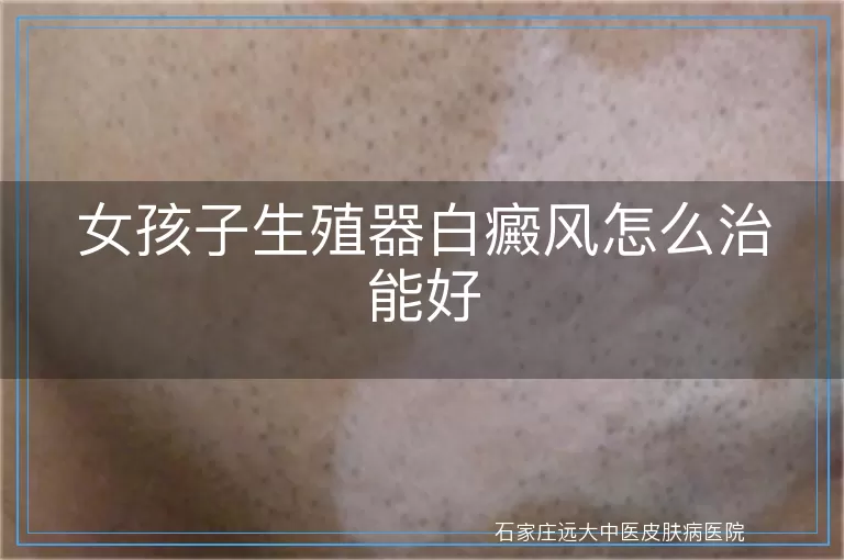 女孩子生殖器白癜风怎么治能好