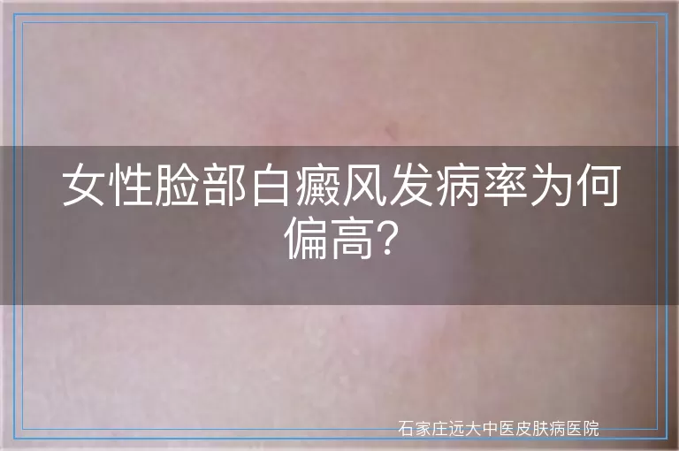 女性脸部白癜风发病率为何偏高？