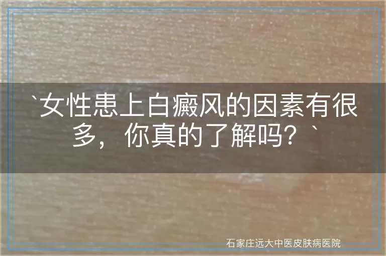 女性患上白癜风的因素有很多，你真的了解吗？