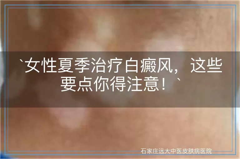 女性夏季治疗白癜风，这些要点你得注意！