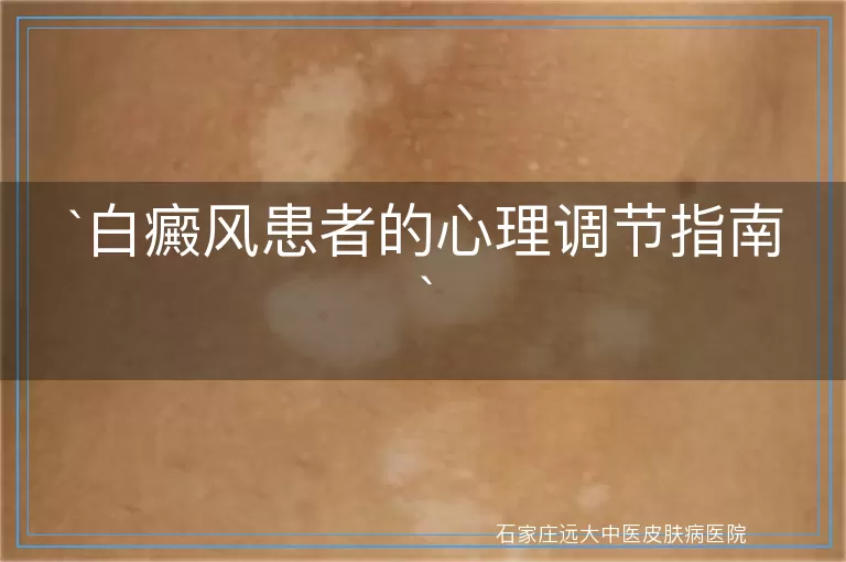 白癜风患者的心理调节指南