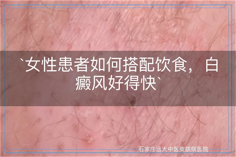 女性患者如何搭配饮食，白癜风好得快