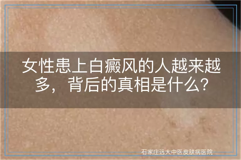 女性患上白癜风的人越来越多，背后的真相是什么？