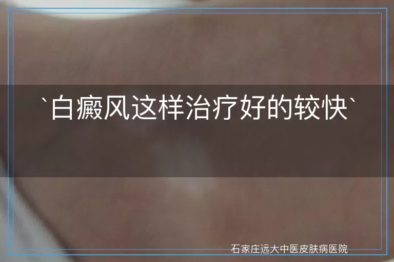 白癜风这样治疗好的较快