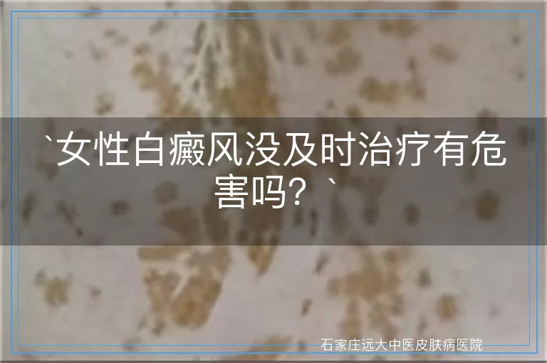 女性白癜风没及时治疗有危害吗？