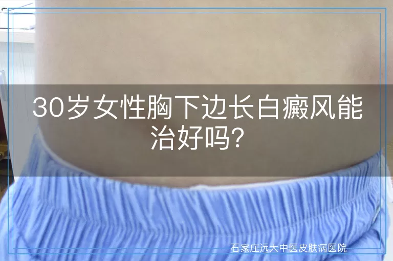 30岁女性胸下边长白癜风能治好吗？