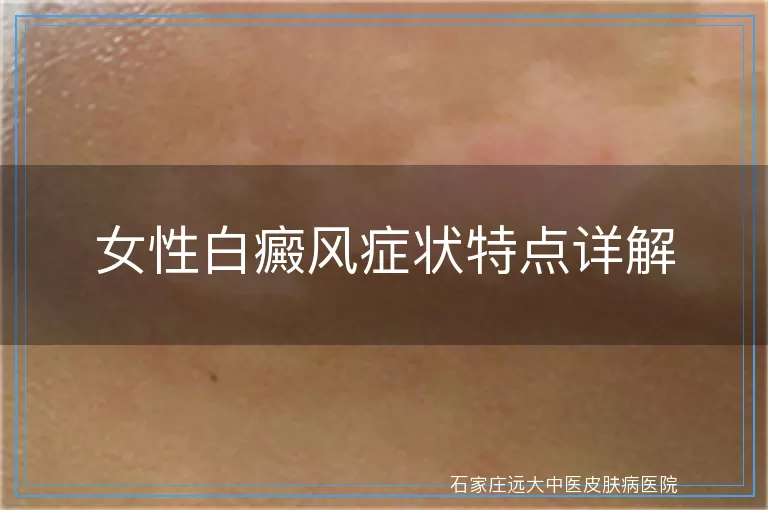 女性白癜风症状特点详解